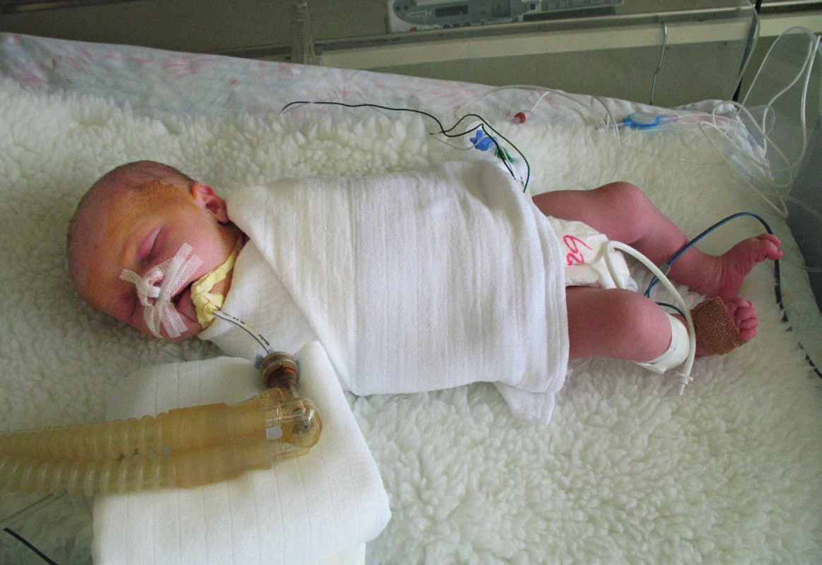 Stav po operaci – 3 hodiny po výkonu (z archivu
MUDr. J. Zacha).<br>
Fig. 2. Post-operative status – 3 hours after early repair
(J. Zach archive).