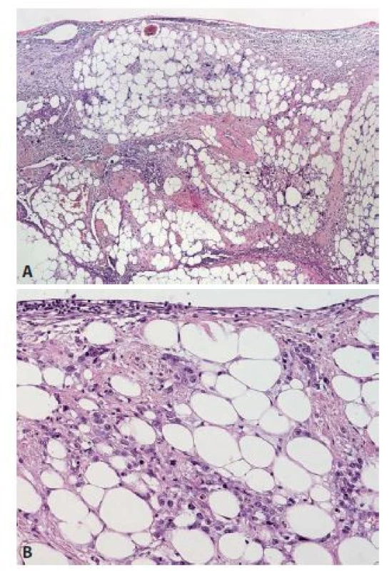 A: Infiltrace mezenteria diseminovaným nádorem s výraznou desmoplasií
ve stromatu (HE, 40x); B: Detail difuzně rostoucích nádorových
buněk bez zřetelného organoidního uspořádání (HE, 200x).
