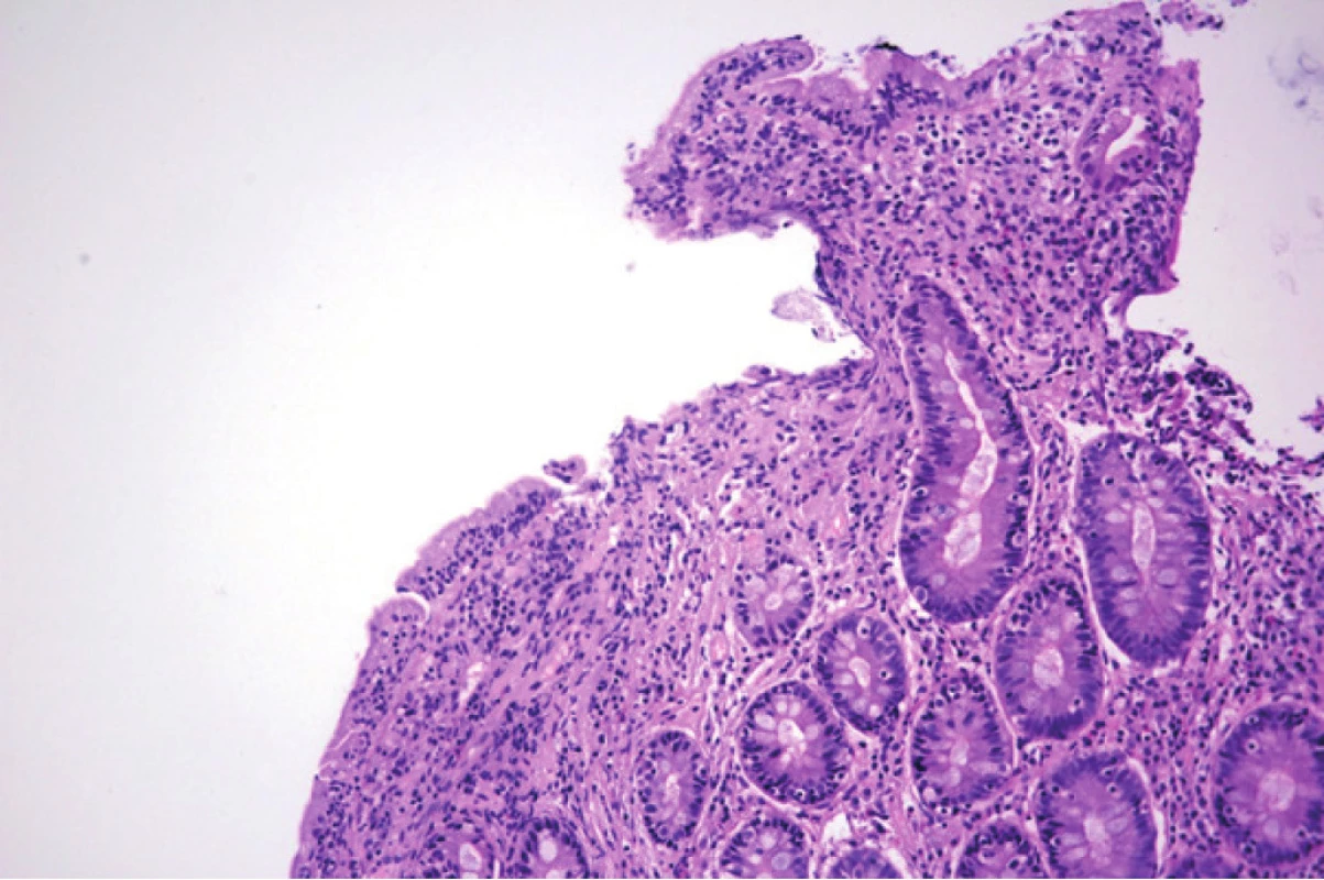 Histologický obraz duodena pacientky. Barveno hematoxylinem
a eozinem, zvětšeno 400×. Zobrazena intraepiteliální lymfocytóza (tj. více
než 30 intraepiteliálních lymfocytů/100 enterocytů).
Obrázek poskytnut MUDr. M. Daumovou, Ph.D. (Šiklův ústav patologie, Fakultní
nemocnice Plzeň)