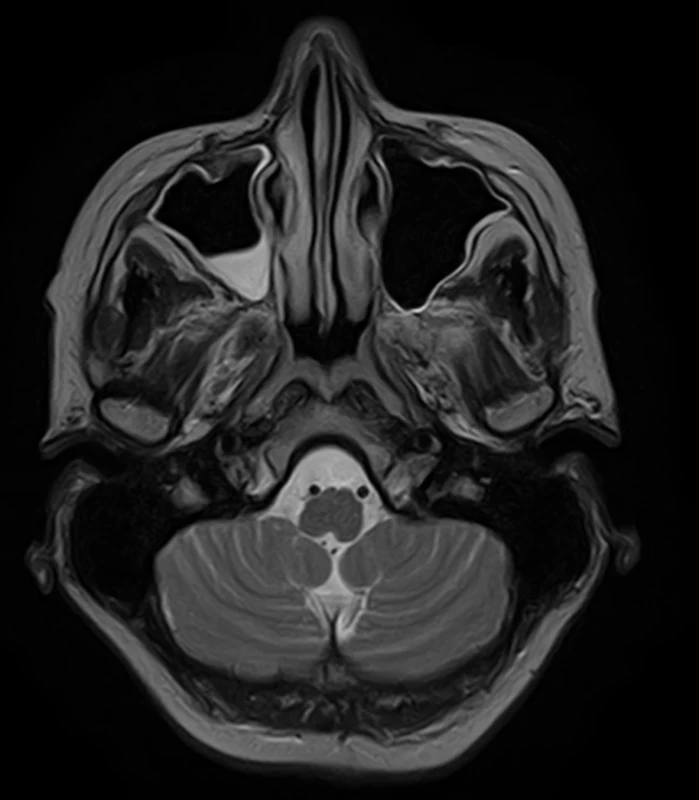 Brain MRI. Axial T2 weighted – sinusitis maxillaris right with edematous and thick mucosa, normal brainstem. <br>
Obr. 1. MR mozku. Axiální T2 vážený snímek – sinusitis maxillaris vpravo s edematózní a zesílenou sliznicí. Normální nález v oblasti mozkového kmene.