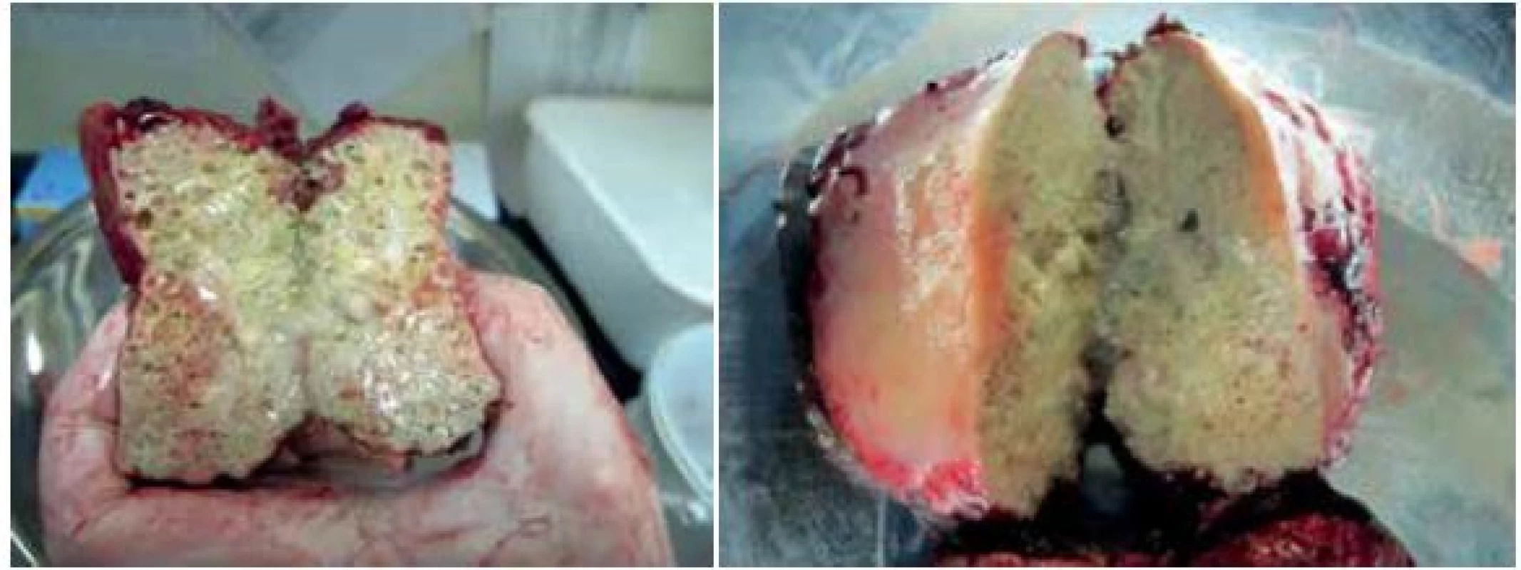 Section of the cyst