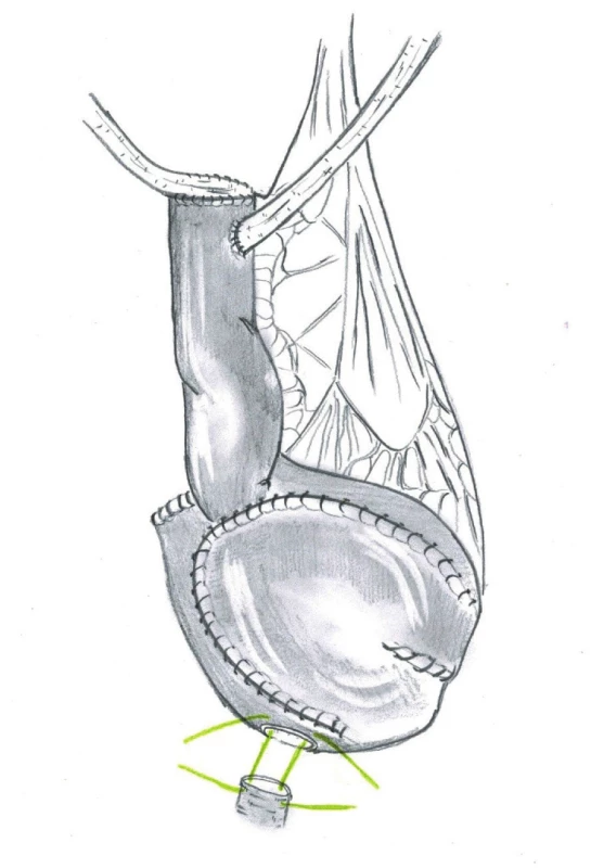Studerova ileální neovezika s mezenteriem
a ureterointestinálními anastomózami<br>
Fig. 1. Studer ileal neobladder with mesentery and
ureterointestinal anastomosis