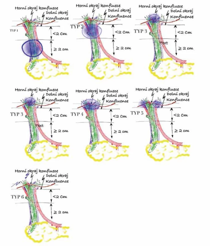Typy poškození žlučových cest podle klasifikace ATOM<br>
Fig.1. Bile duct injuries according to ATOM classification