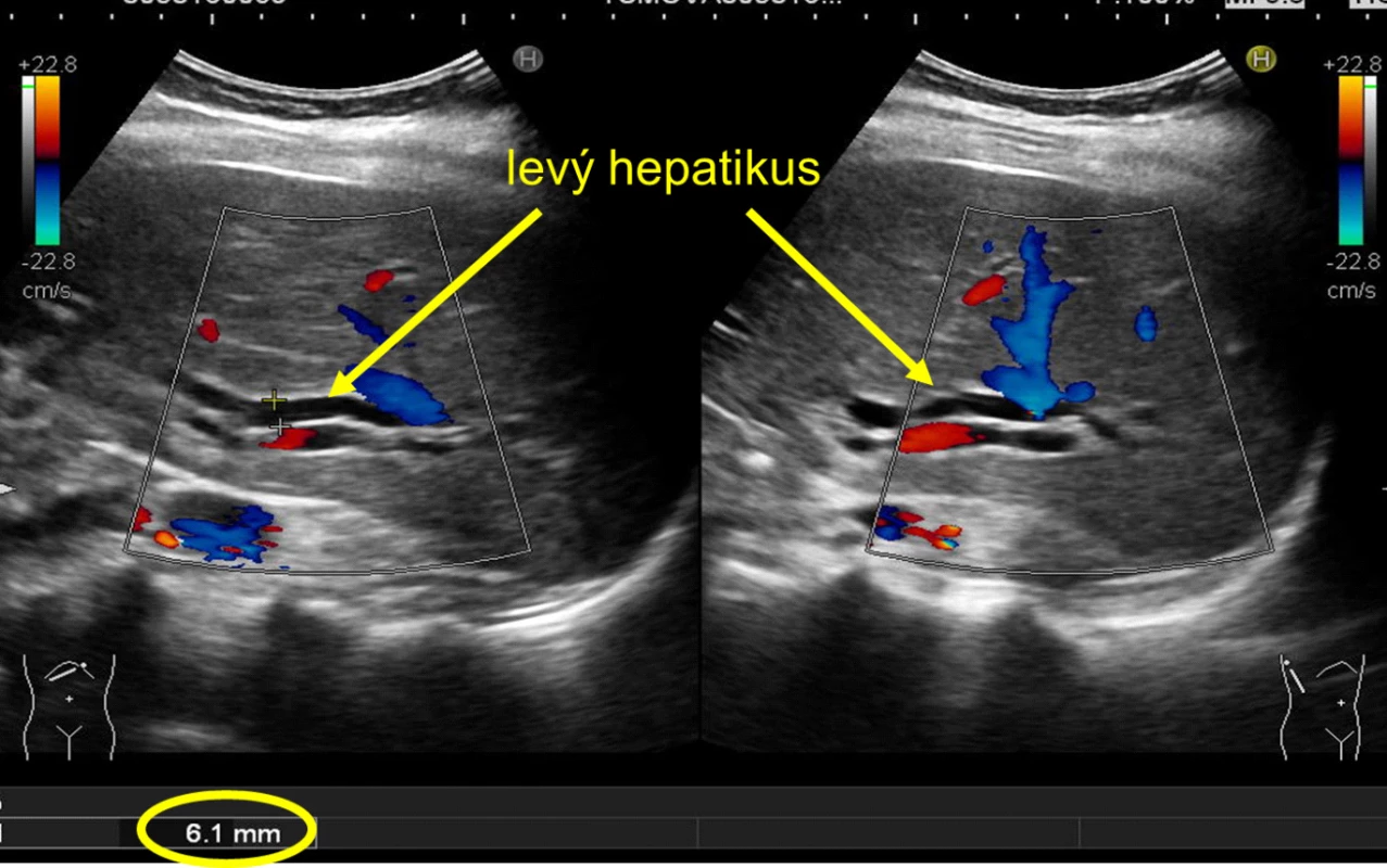 Dilatace hepatiků na UZ břicha<br>
Fig. 1: Dilation of hepatic ducts using abdominal ultrasound scan