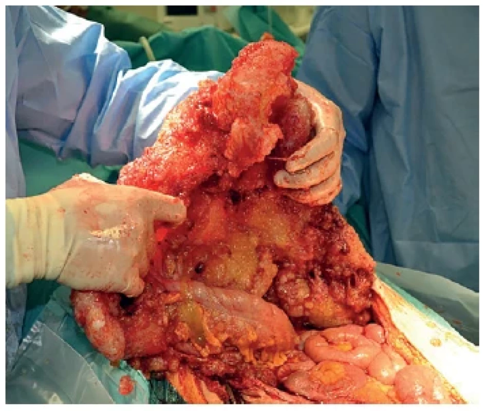 Omental cake u pseudomyxomu peritonea <br> 
Fig. 1. Omental cake in pseudomyxoma peritonei