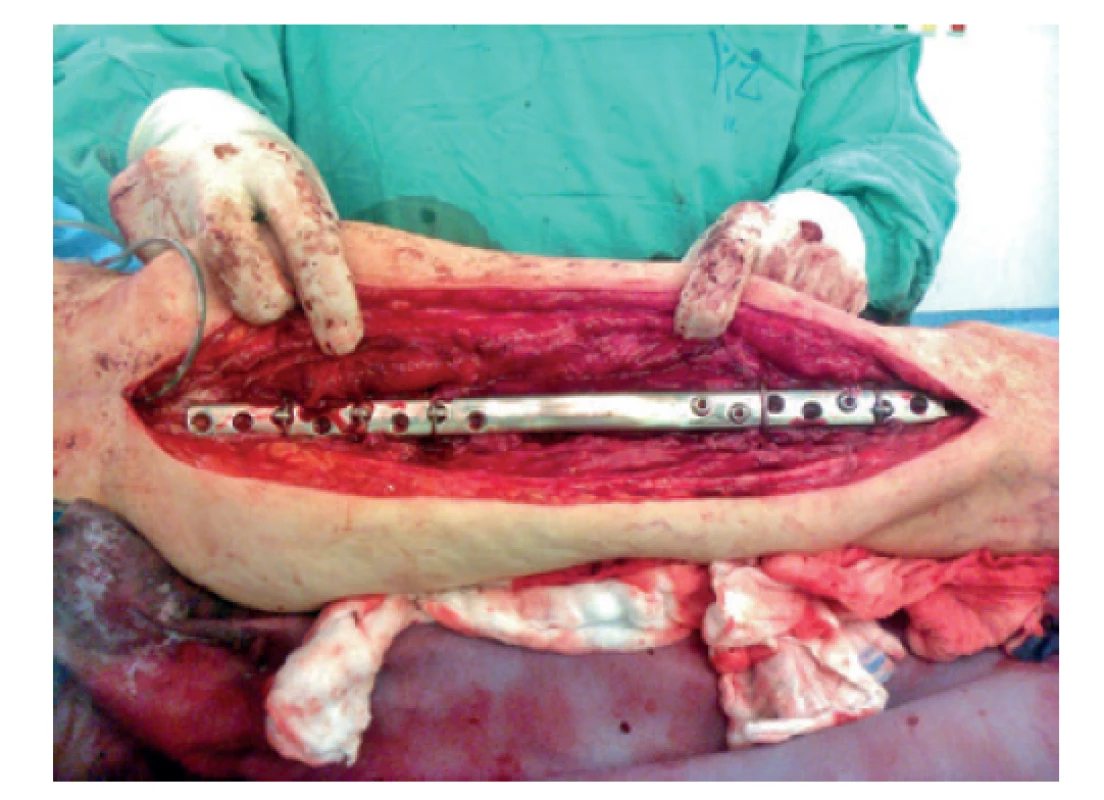 Peroperační foto – 3. reoperace (předehnutá dlaha)<br>
Fig. 8: Intraoperative picture – the 3rd revision surgery
(wave plate)