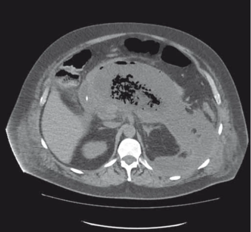CT břicha – rozsáhlá ohraničená pankreatická nekróza
se solidními sekvestry a obsahem plynu.<br>
Fig. 1. Abdominal CT – extensive walled-off pancreatic necrosis
with solid sequestration and gas content.