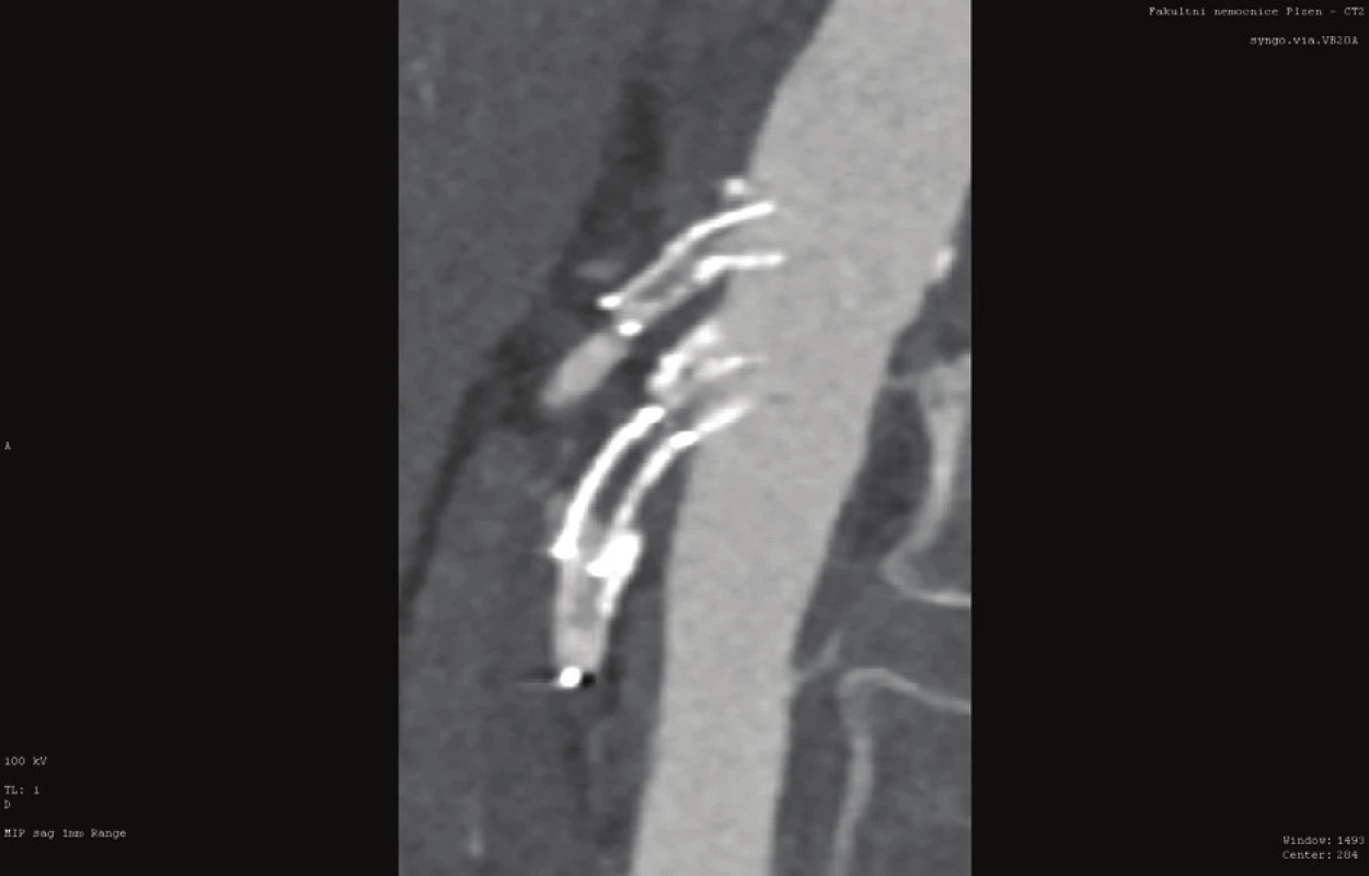 Opakované endovaskulární intervence na TC
a AMS (CT AG)<br>
Fig. 5: Recurrent endovascular interventions on the celiac
trunk and superior mesenteric artery (CT AG)