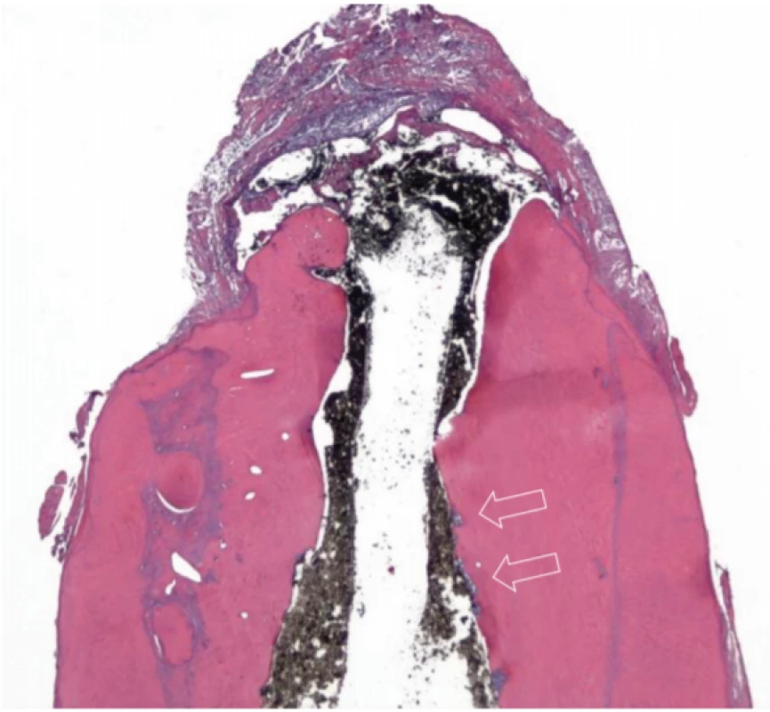 Longitudinální histologický
řez apikální části nabarvený
hematoxylin-eozinem;
je zde přítomna velká
apozice nově produkované
mineralizované tkáně bez
tubulárních struktur, která je
oddělna bazofilní linií; šipky
směřující k oblastem resorpcí
vyplněným nekrotickou tkání
(zvětšeno 16×)<br>
Fig. 2
Longitudinal histological
section of apical part stained
with hematoxylin-eozin;
there is abundant deposition
of newly produced mineralized
tissue with no tubular
structure which is demarcated
by basophilic layer; arrows
point to areas of resorption
filled with necrotic tissue
(magnification 16×)