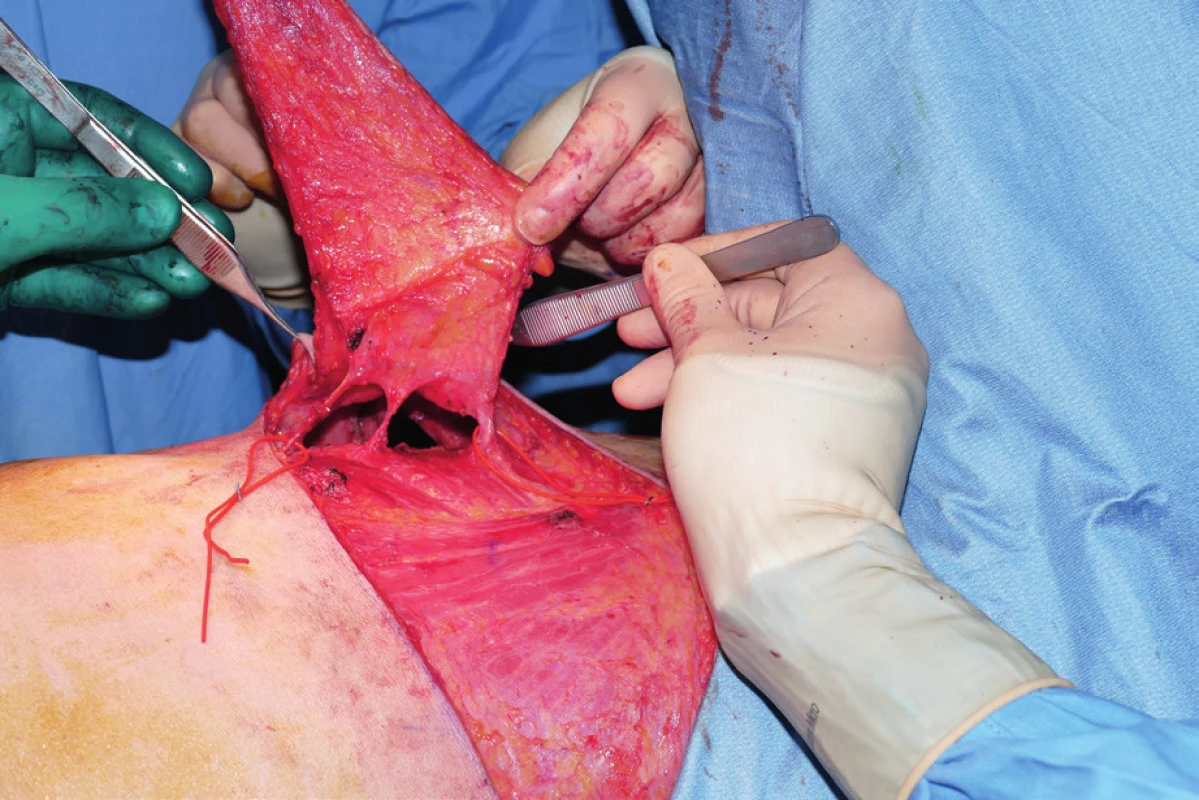 Flap harvested on three perforators of the lateral intercostal
artery