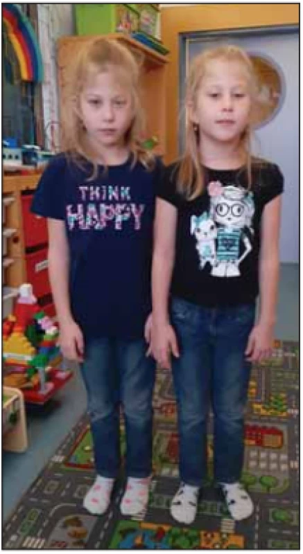 Sestry (dvojčata) se SMA III.<br>
Fig. 8. Sisters (twins) with SMA III.