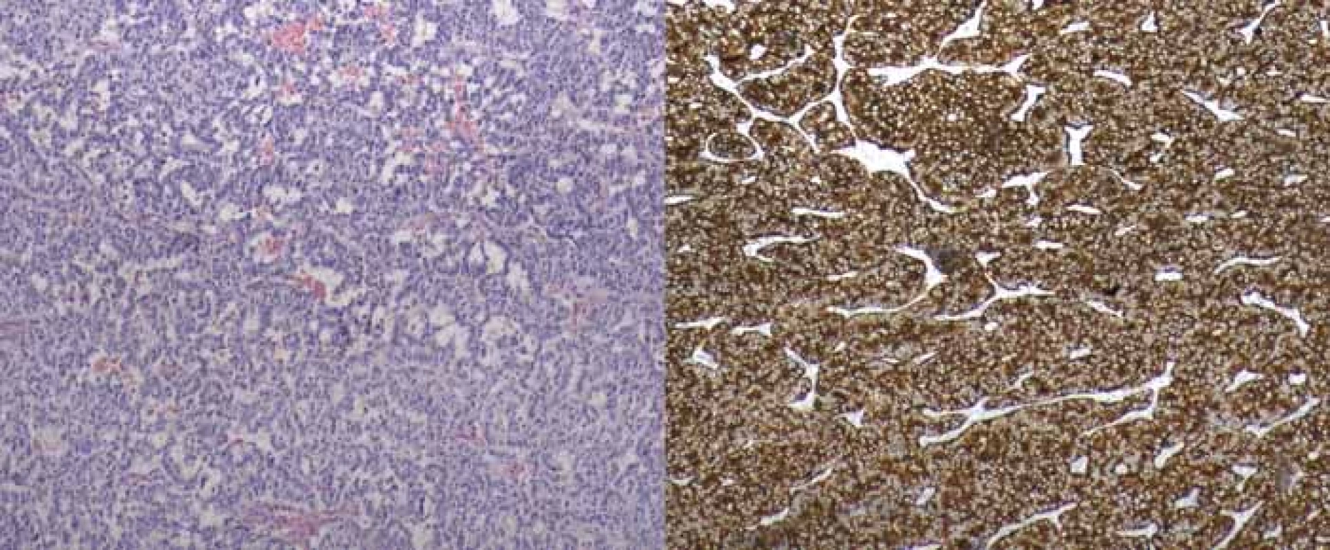Histologický obraz gatrinomu kaudy pankreatu (WHO 2010 grade 2), vpravo imunohistochemické barvení.<br>
Fig. 4. Histological picture of gastrinoma of pancreatic tail (WHO 2010 grade 2), imunohistochemical staining on the right.