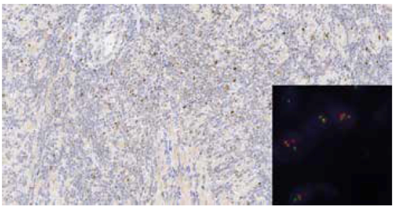 Imunohistochemický průkaz cyclin D1 – slabá nehomogenní pozitivita
(zvětšeno 40x), v pravém dolním rohu vložen obrázek z FISH vyšetření,
pozitivní t(11;14) – abnormální přítomnost jednoho červeného a jednoho zeleného
signálu a dále dvou žlutých signálů v jedné buňce (zvětšeno 1000x).