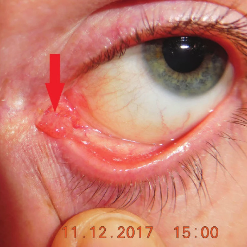 Klinický obraz u pacienta s papilómom karunkuly