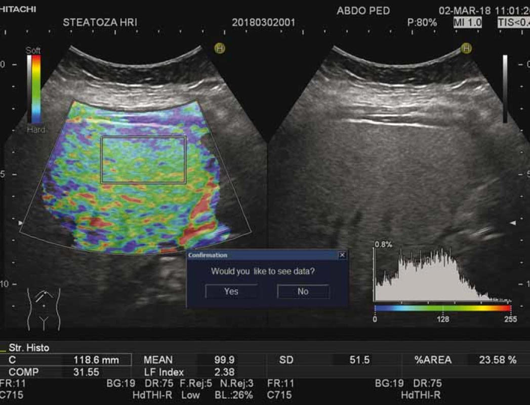 Hodnotenie elasticity pečene pomocou real-time elastografie.<br>
Fig. 2. Evaluation of liver elasticity using real-time elastography