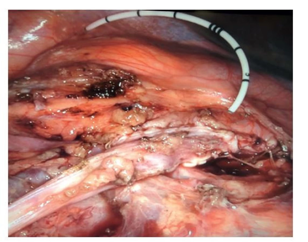 Pyelo-ureterální anastomóza ventrálně od aberantních
cév a perkutánní ureteropyelostomický drén vyvedený
stěnou pánvičky a stěnou břišní<br>
Fig. 3: Pyeloureteral anastomosis made ventrally from
the aberrant vessel(s) and the percutaneous ureteropyelostomy
drain brought out through the abdominal wall