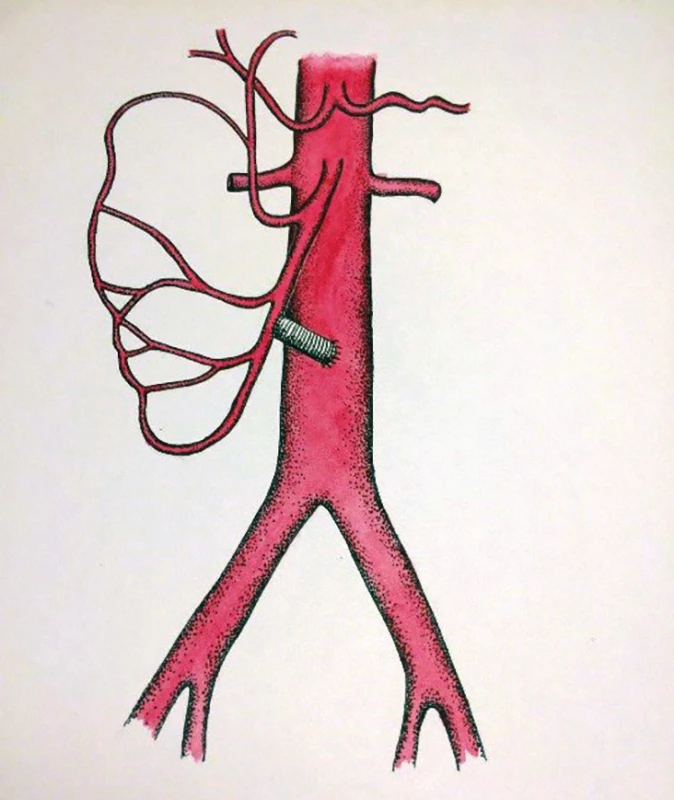 Retrográdní bypass na AMS
(schéma MUDr. Táňa Baráková)<br>
Fig. 7: Retrograde bypass on the superior
mesenteric artery