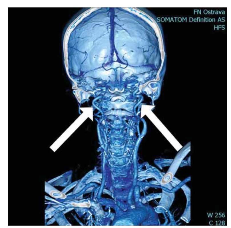 Tortuosity a. carotis interna oboustranně.<br>
Fig. 3. Tortuosity of the internal carotid artery on both sides.
