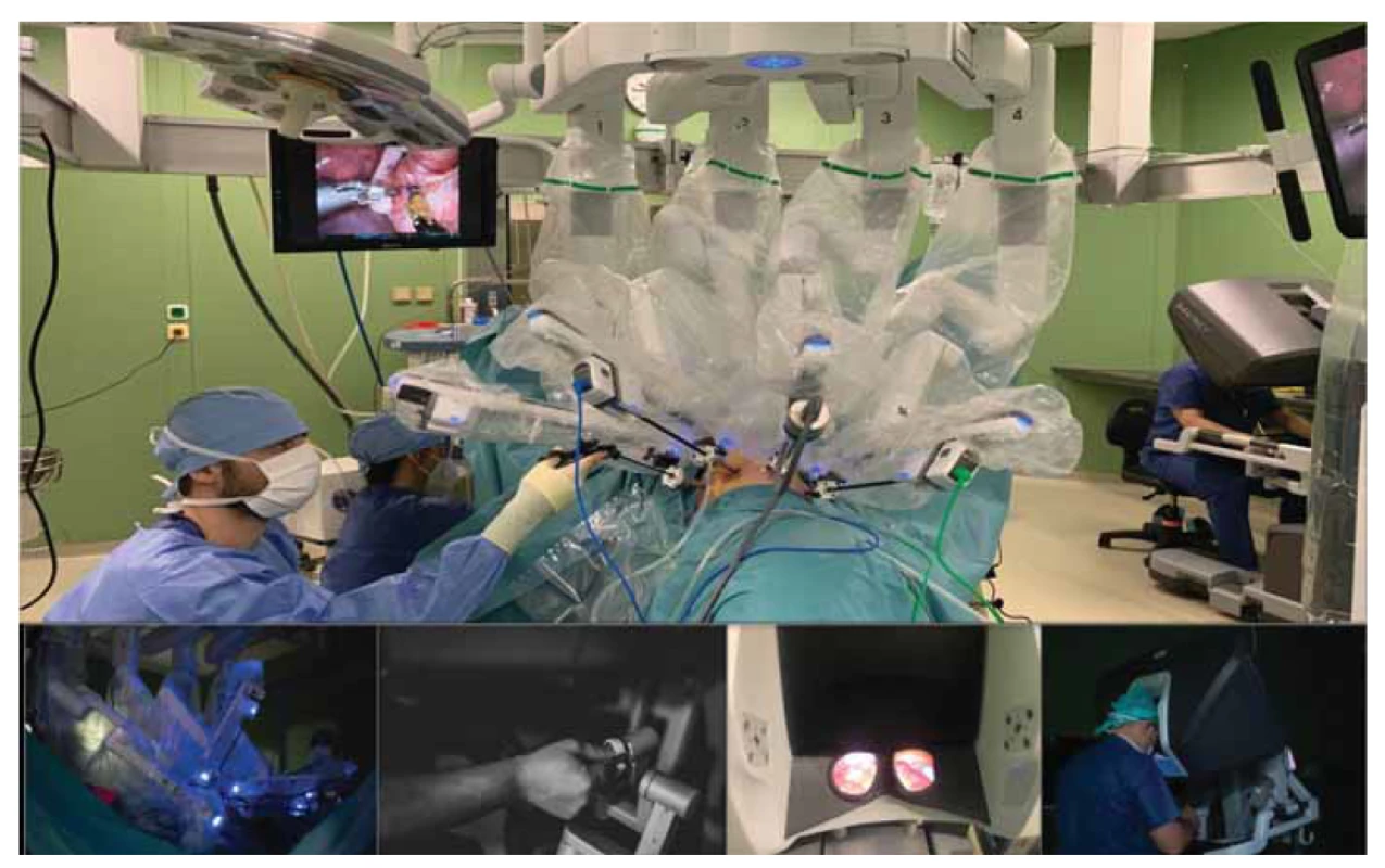 Robotický chirurgický systém Da Vinci® Xi během výkonu. Operující chirurg ovládá robotický manipulátor prostřednictvím
konzole v pravé části obrázku.<br>
Fig. 1. Da Vinci® Xi robotic surgical system during the procedure. The operating surgeon controls the robotic manipulator
via a console in the right part of the image.