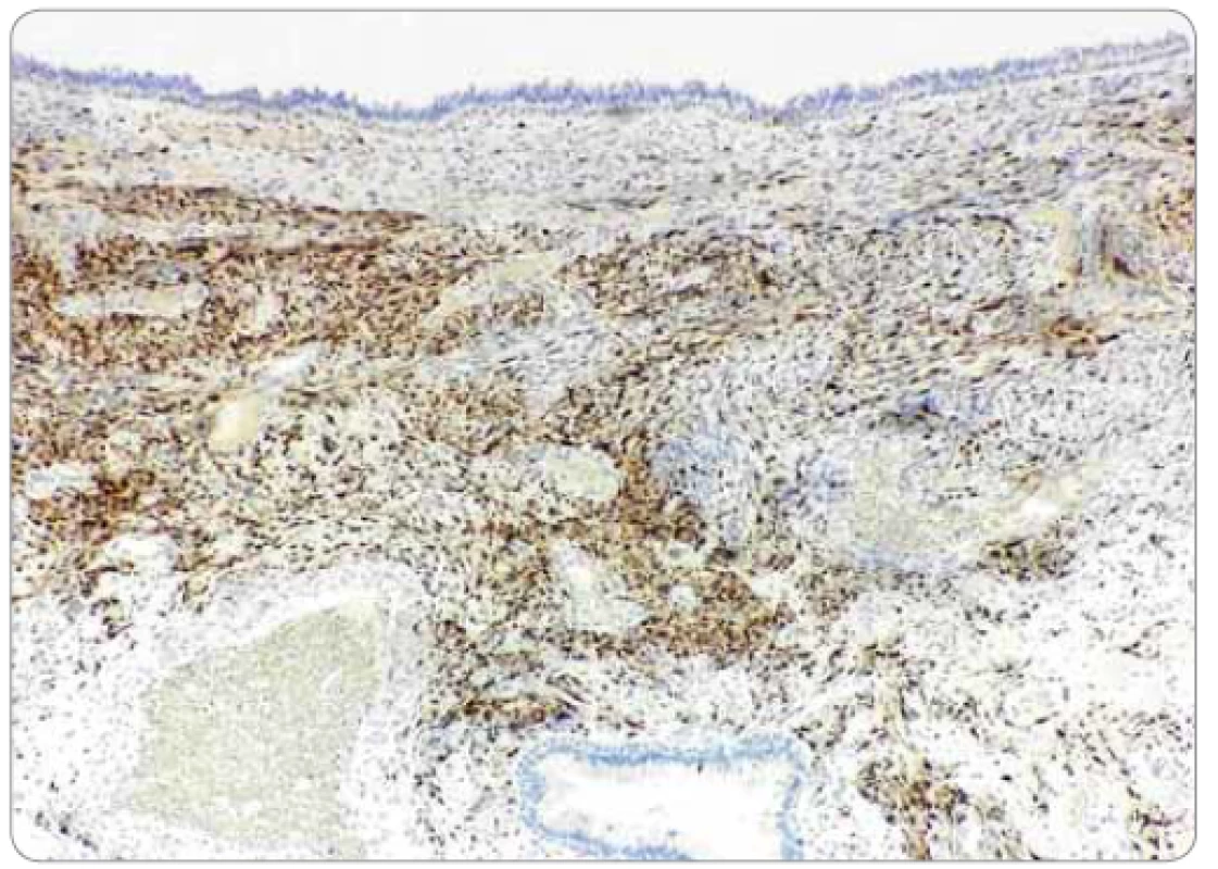 Imunohistochemická reaktivita nádorovobunkovej populácie na proteín S100
(zväčšenie 40×).