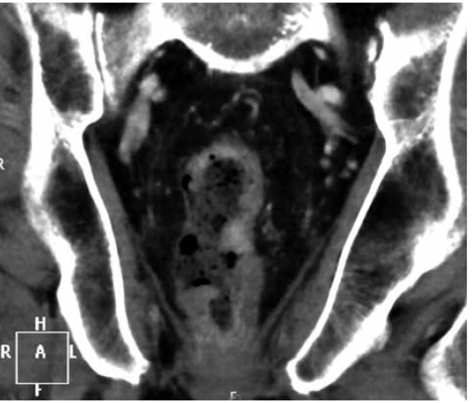 Koronární řez CT pánve s infiltrací rekta lymfomem<br>
Fig. 1. Coronal pelvic CT scan with tumorous infiltration
of rectum