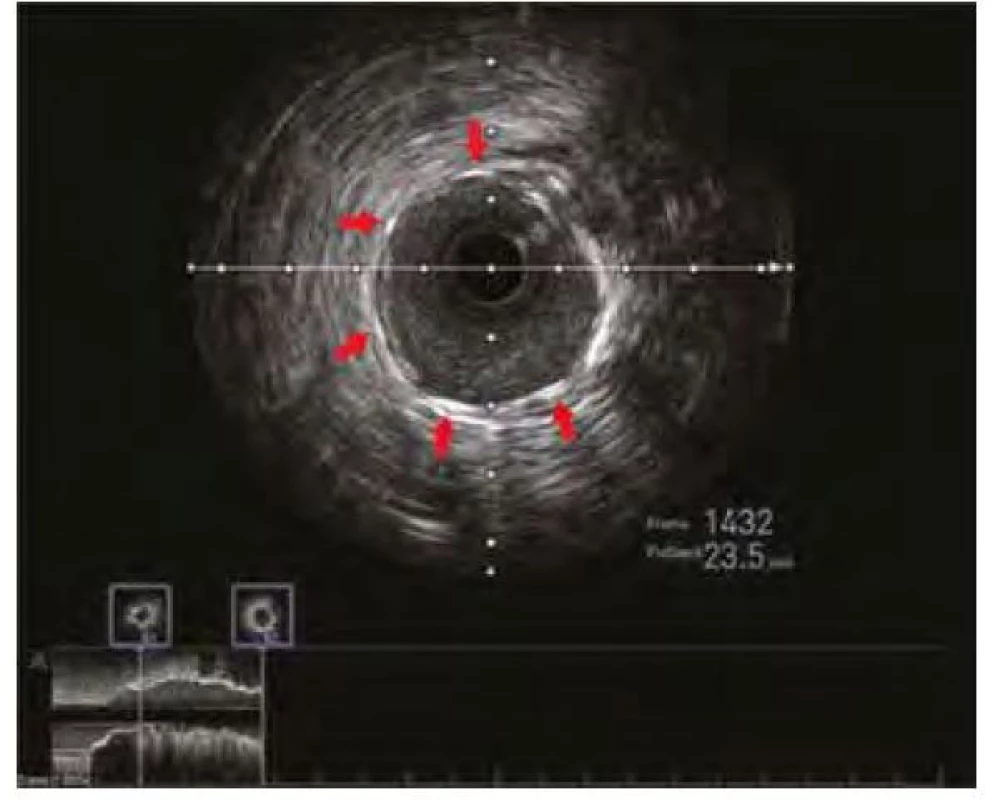 Kontrolní IVUS s vizualizací optimálního uložení, expanze a apozice
koronárního stentu. Červené šipky ukazují struty koronárního stentu