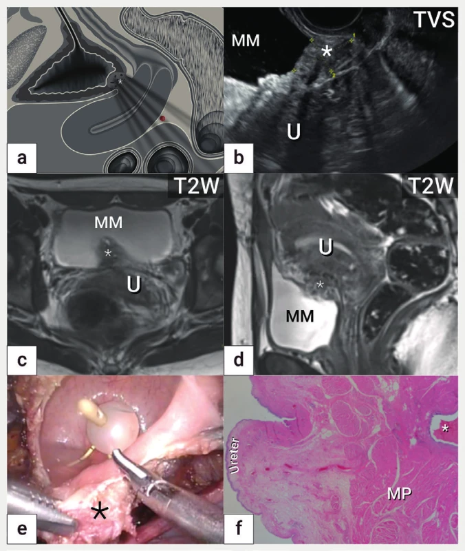 Hluboká endometrióza močového měchýře<br>
Schéma v sagitální rovině s nálezem hluboké endometriózy (označena
hvězdičkou) v bazi močového měchýře (a), léze ohraničena kalipery
(hvězdička) v ultrazvukovém zobrazení v sagitální rovině (b) léze
v magnetické rezonanci v koronární rovině (c) a sagitální rovině (d),
laparoskopická cystotomie s resekcí ložiska hluboké endometriózy
(hvězdička) po zavedení intraureterálních stentů (e), mikroskopický
nález hluboké endometriózy s přítomností endometriálních žlázek
a stromatu (f)<br>
MM – močový měchýř, MP – muscularis propria, U – uterus, TVS –
transvaginální sonografie, T2W – T2 vážené obrazy v magnetické
rezonanci