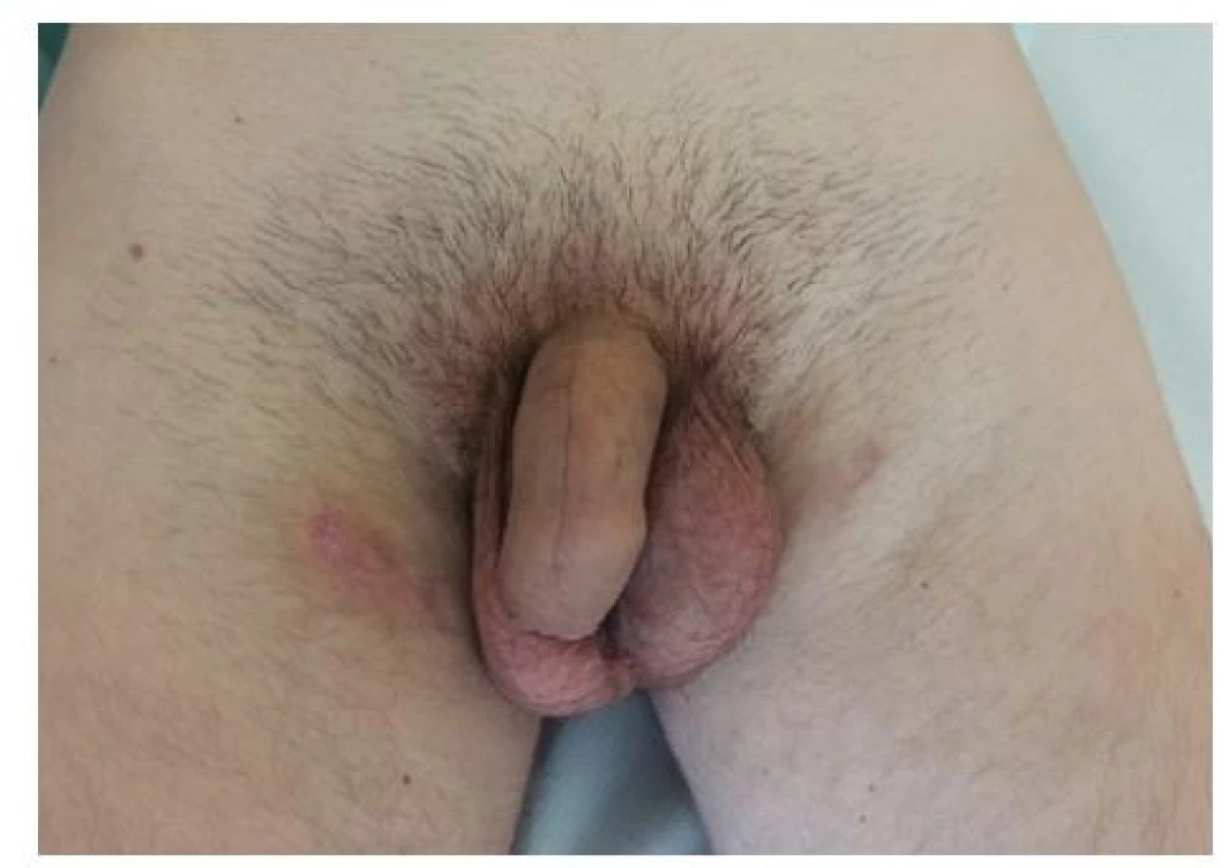 Klinický nález 5 týdnů po úrazu<br>
Fig. 6. Clinical outcome 5 weeks after the injury