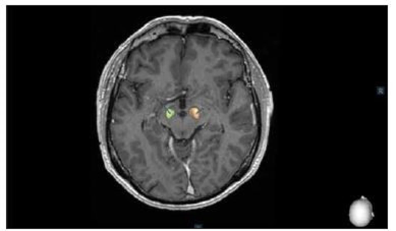 Postoperative control of deep brain stimulation in the subthalamic
nucleus using the SureTune® software (Medtronic,
Dublin, Ireland).<br>
Obr. 2. Pooperační kontrola uložení elektrod hluboké mozkové
stimulace v subtalamickém jádru pomocí systému SureTune®
(Medtronic, Dublin, Irsko).