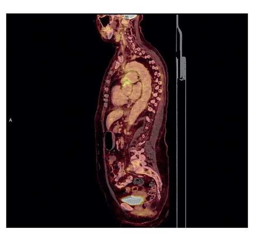 FDG-PET/CT (sagitálny rez – fúzovaný PET/CT obraz)<br>
Bez aktívnej vaskulitídy, mierne zvýšenie metabolickej aktivity
v oblasti prostetického materiálu v oblasti ascendentnej
aorty (4 mesiace po operácii).<br>
Fig. 4: FDG-PET/CT (sagittal view – PET/CT image)<br>
Image show no active aortitis changes and small FDG uptake
around prosthetic material implanted into the ascending aortic
position (four months after the operation).