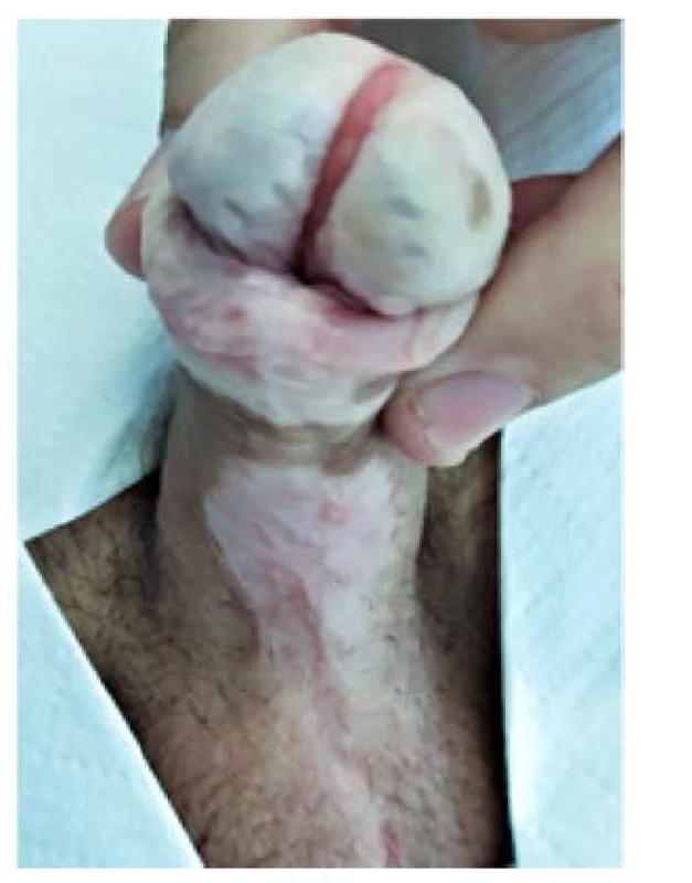 Vzhled dva roky po operaci<br>
Fig. 8. Final appearance two years
after surgery