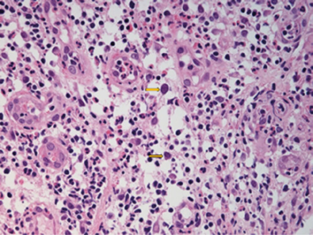 CMV inkluze – označeno šipkami, HE staining, 400×