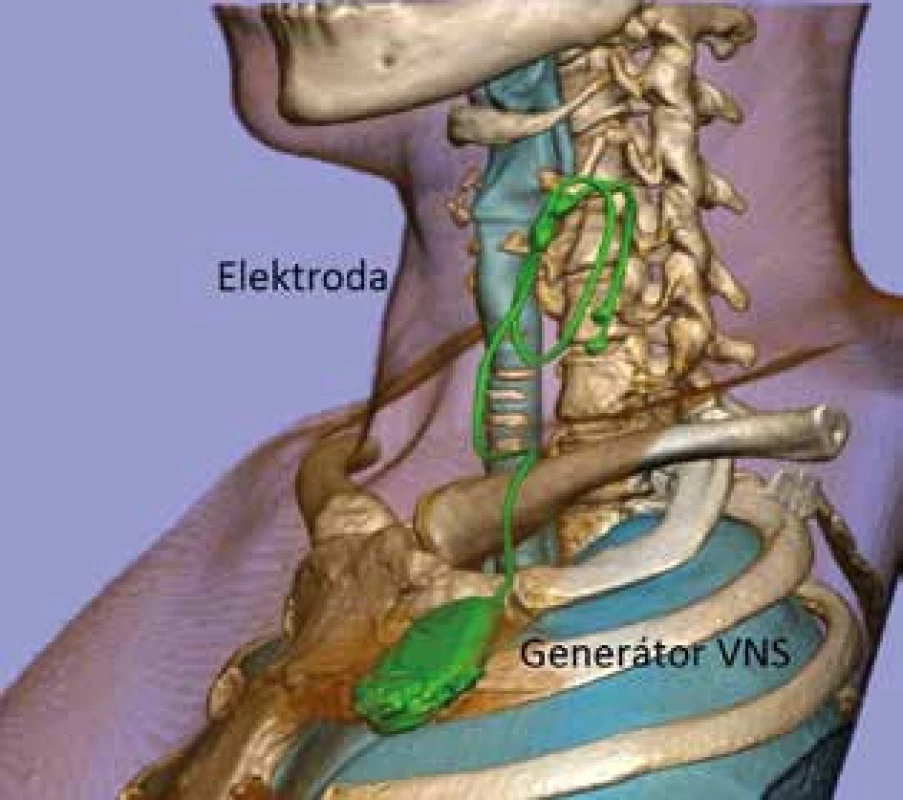 Vagový stimulátor<br>
Fig. 1: Vagus nerve stimulator