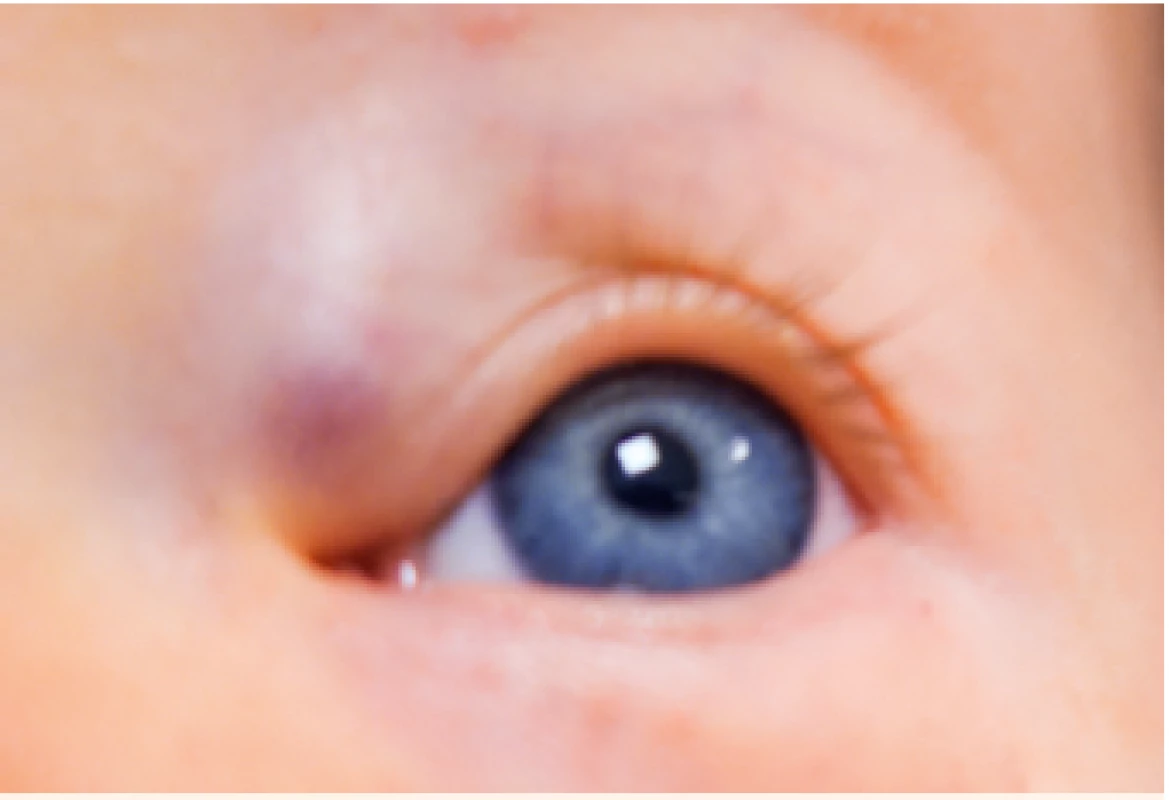 Hluboký IH horního víčka.<br>
Deep IH of the upper eyelid.