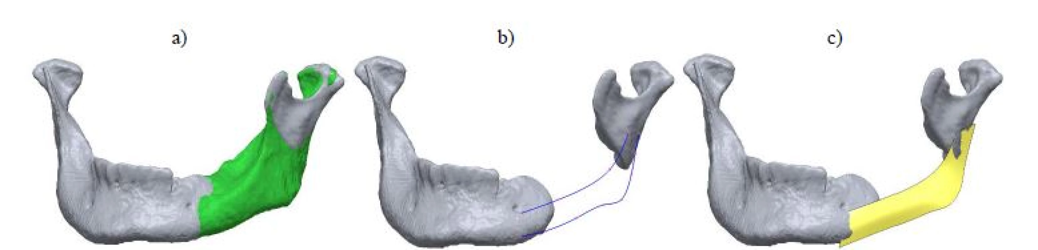 Design process of the mandibular implant a) initial mirror, b) guidance 3D curves and c) outer surface of the mandibular implant.