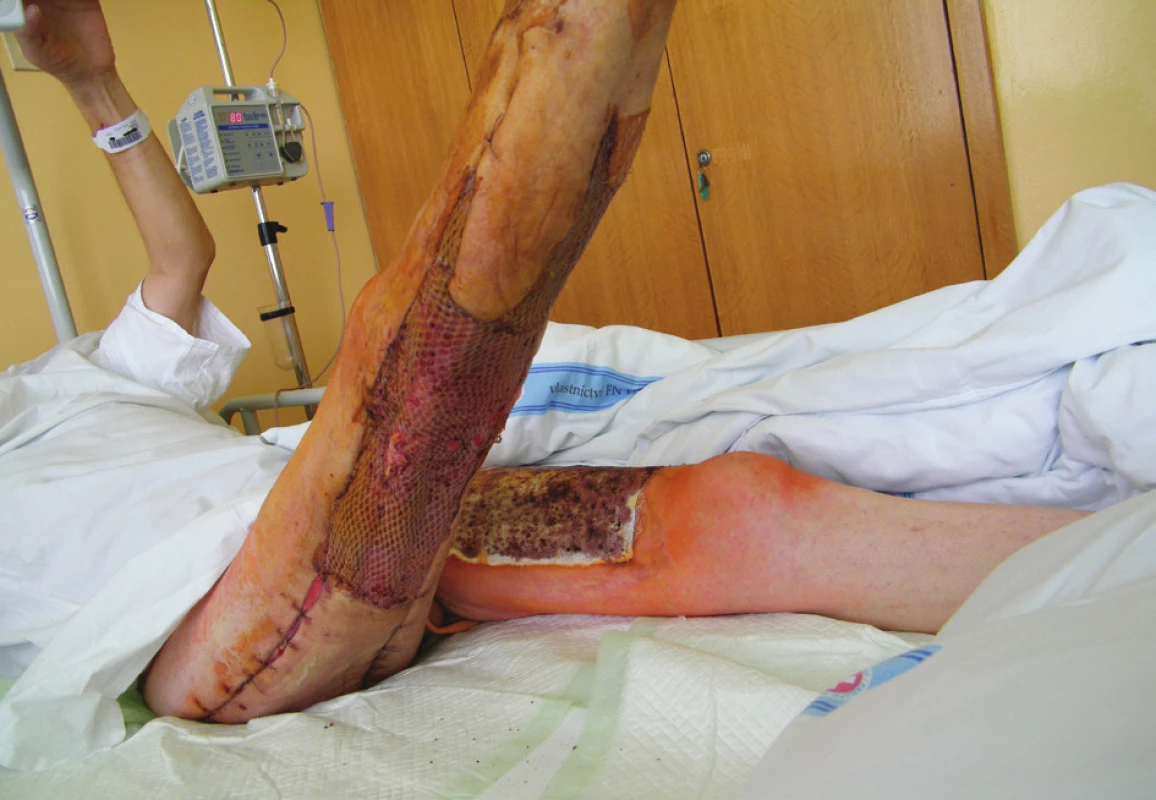 14. den po transplantaci – všechny štěpy přihojeny
(18. 7. 2014)<br>
Fig. 3: 14 days after grafting – all grafts healed in