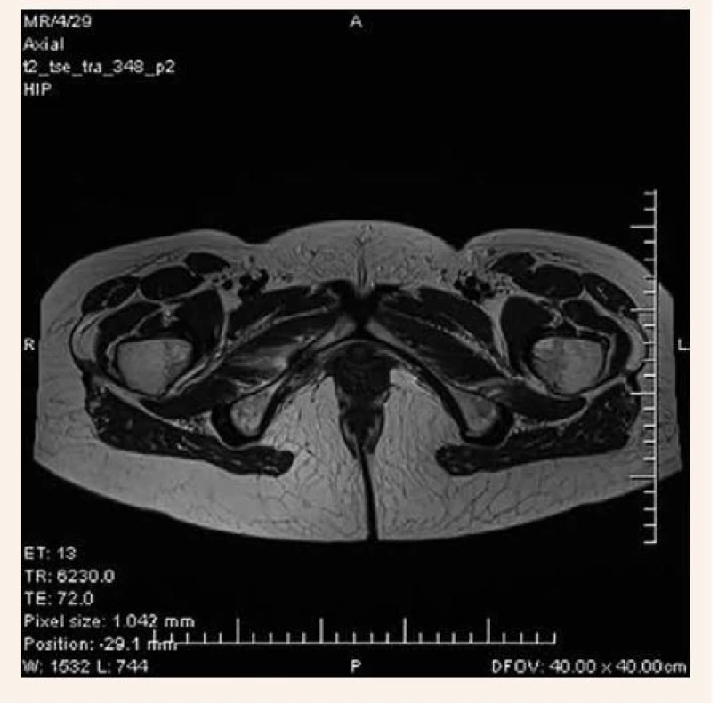 MRI-vyšetrenie 2 mesiace od začiatku bolestí
s popísanou insuficientnou zlomeninou dolného
ramienka lonovej kosti vpravo