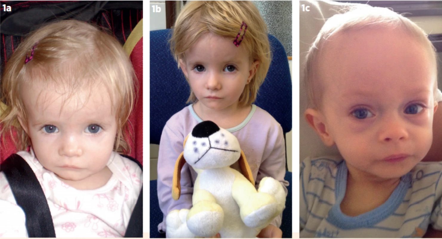 a, b. Dívka se Silverovým-Russellovým syndromem na podkladě hypometylace na chromosomu 11 (11p15-SRS). Narodila ve
38. týdnu těhotenství SGA (small-for-gestational-age) – porodní hmotnost 1700 g, délka 42 cm. I po narození málo
rostla a neprospívala (a – věk 18 měsíců, b – věk 4 roky). 1c) Chlapec se Silverovým-Russellovým syndromem na podkladě mateřské uniparentální disomie krátkého raménka 7. chromosomu (UPD7). Narodil se ve 36. týdnu těhotenství
s hmotností 1900 g a délkou 42 cm (SGA). Od útlého věku byl vyšetřován pro neprospívání, ve věku 1 rok (obr.) vážil
4 kg.<br>
Fig. 1a, b. A girl with Silver-Russell syndrome due to hypomethylation on chromosome 11 (11p15-SRS). She was born at 38th gestational week small-for-gestational-age – with birth weight 1700 g and birth length 42 cm. She failed to thrive and
to grow even postnatally (a – age 18 months, b – age 4 years). 1c. A boy with Silver-Russell syndrome due to maternal
uniparental disomy of short arm of 7th chromosome (UPD7). He was born at 36th gestational week with birth weight
1900 g and birth length 42 cm (SGA). Since early childhood, he failed to thrive and his weight was 4 kg when aged
1 year (fig.)