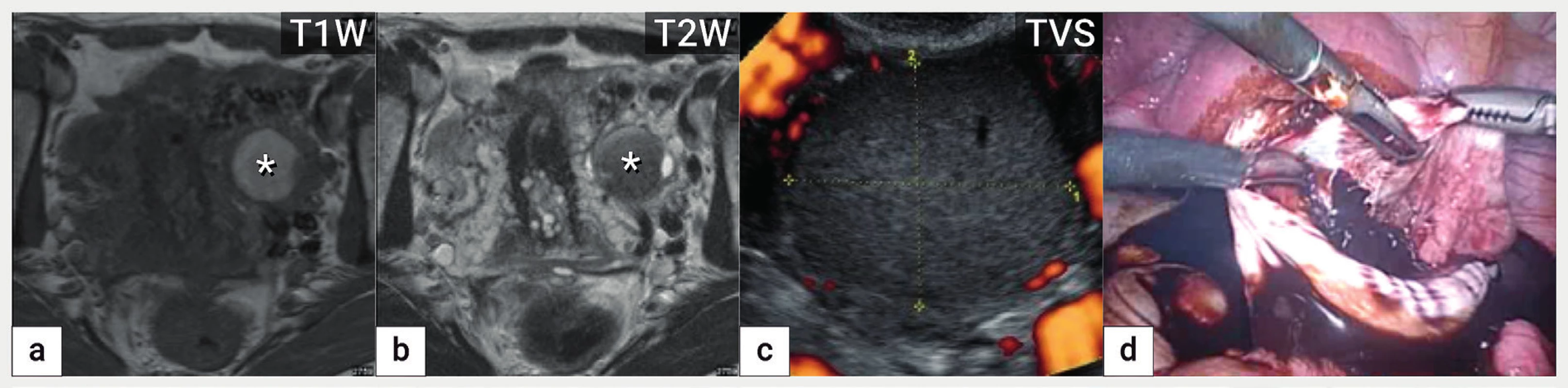 Endometroidní cysta<br>
Zobrazení endometroidní cysty v magnetické rezonanci na podkladě přítomnosti rozpadových produktů hemoglobinu, která je v T1 váženém
obrazu hyperintenzní (zvýšený signál) (a) a v T2 váženém obraze hypointenzní (tzv. shading) (b), v ultrazvukovém zobrazení patrná avaskulární
unilokulární cysta s denzní hypoechogenní intracystickou tekutinou (c) a intraoperační nález z laparoskopické cystektomie (d).
T1W a T2W – T1 a T2 vážené obrazy v magnetické rezonanci, TVS – transvaginální sonografie
