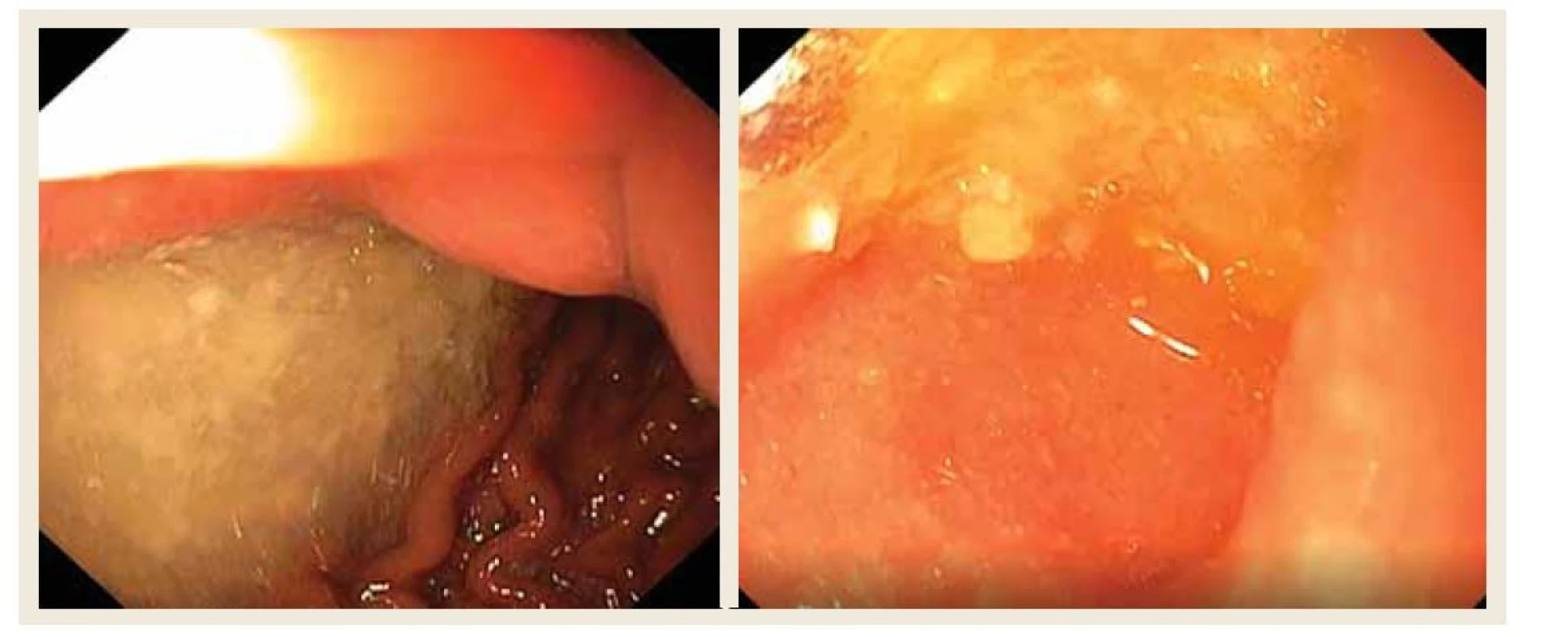 Endoskopický obraz žaludku a duodena.<br>
Fig.2. Endoscopic image of the stomach and duodenum.