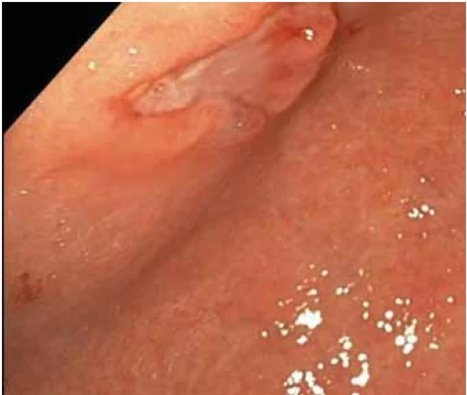 Vředová léze na přední stěně na přechodu těla a antra žaludku – první kontrolní gastroskopie.</br>Fig. 3. Ulcer lesion on the front wall at the junction of the body and antrum of the stomach – the first control gastroscopy.