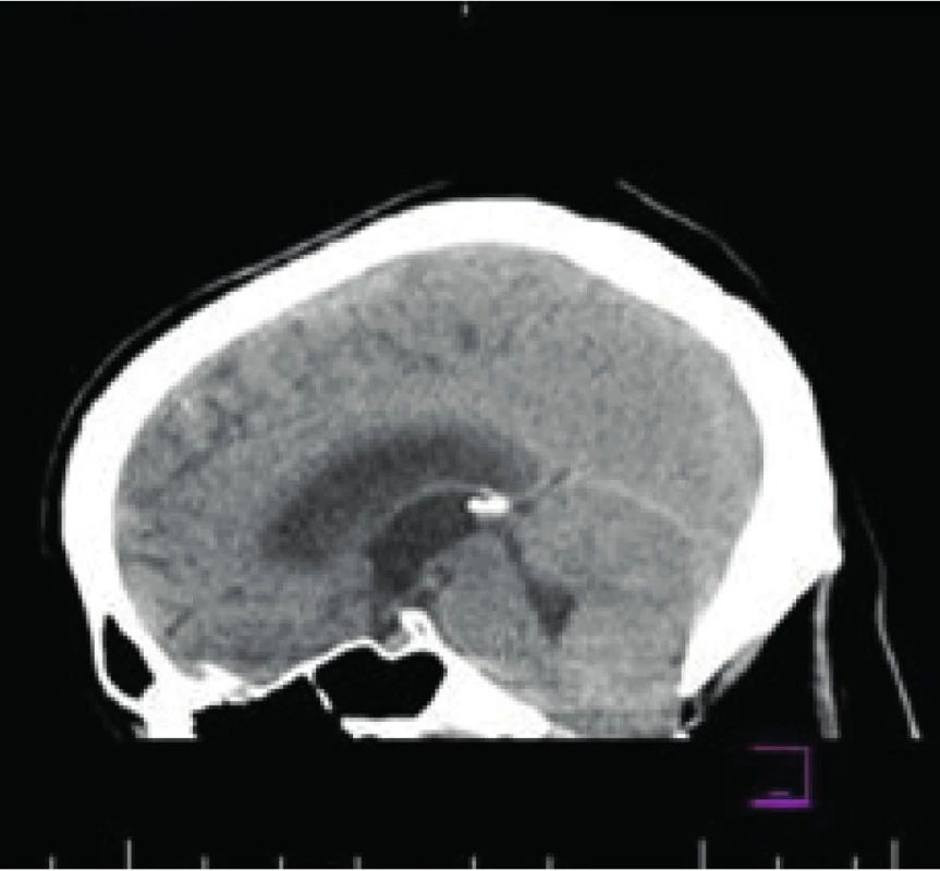 MRI mozgu a cervikálnej chrbtice. Obraz incipientného zápalového
procesu cerebellárnych hemisfér s patologickými signálovými zmenami
prevažne v oblasti kortiko-medulárnej junkcie hemisfér kaudálne a edémom
s protrúziou cerebellárnych tonzíl do foramen magnum a incipientným
3-komorovým hydrocefalom s naznačeným miernym transependymálnym
prienikom likvoru
