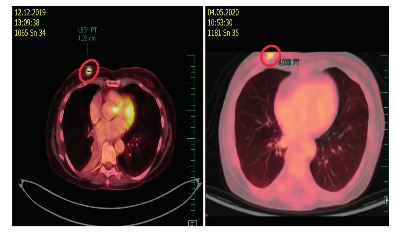 PET/CT. Částečná regrese metastázy v pravé mammě