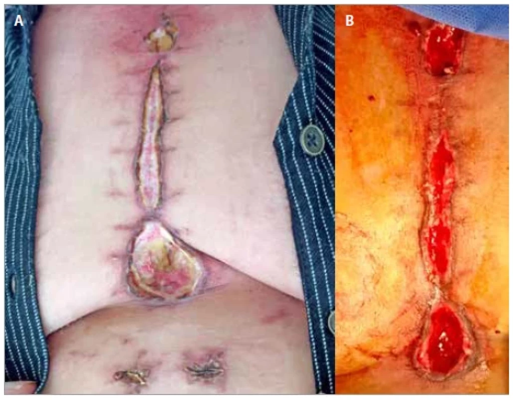 A) Superficial wound infection – post-cardiac transplant; B) after 42 days
of dressing.
