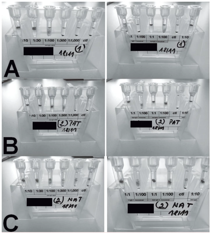 PAT/NAT u pacienta 1<br>
A – PAT, retikulocyty, periferní krev<br>
B – PAT, erytrocyty periferní krev<br>
C – NAT, plazma