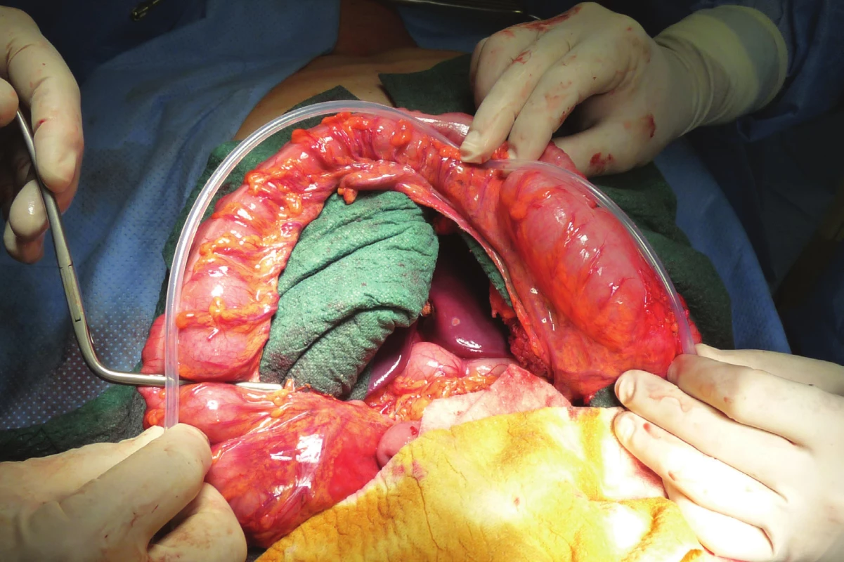 Bužie k měření
délky kolického
interponátu<br>
Fig. 4: A bougie used to
measure the length of
the colonic interponate