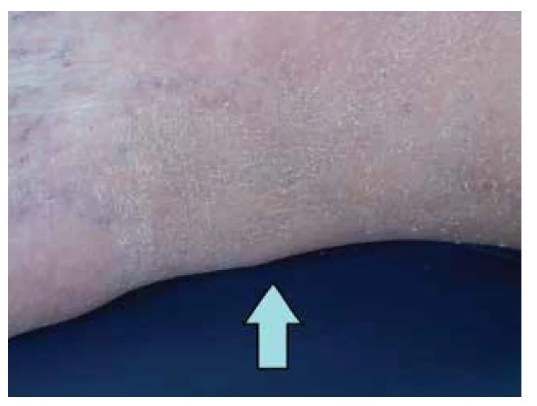Xanthoma tendineum (Achillovy šlachy)