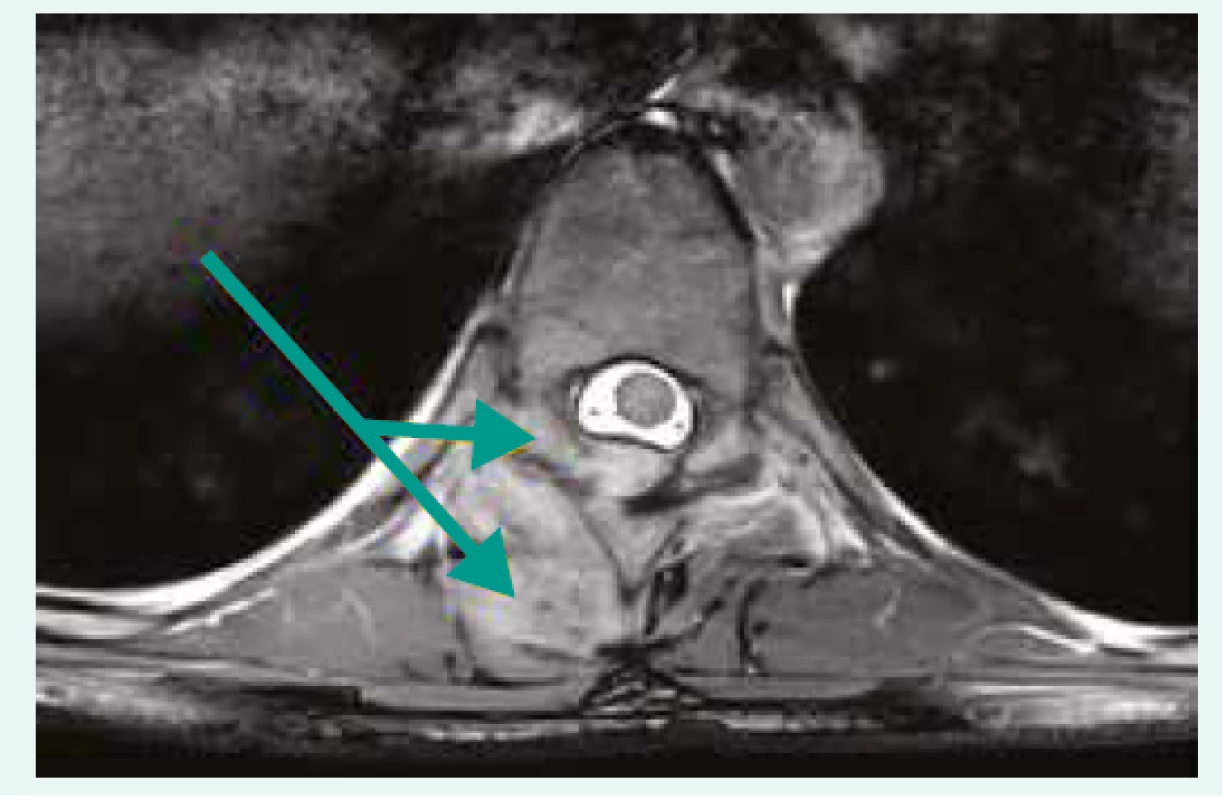 MRI – the SEA in thoracic spine,
transversal scan. Department of Radiology,
and Nuclear Medicine