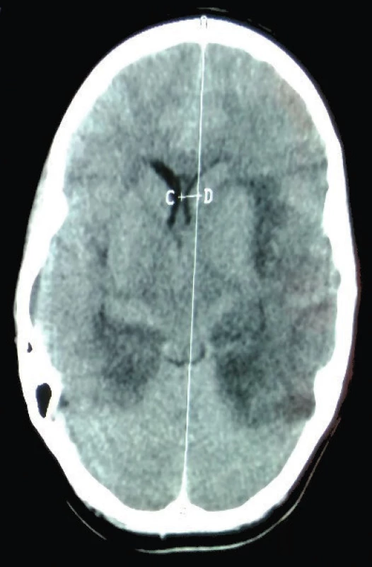CT mozgu. 9. deň ochorenia: Obraz encefalitídy obojstranne, herniácia falxu doprava. <br>
Fig. 2.  CT of brain. 9th day of illness: Picture of encephalitis on both sides, hernia falx to the right.