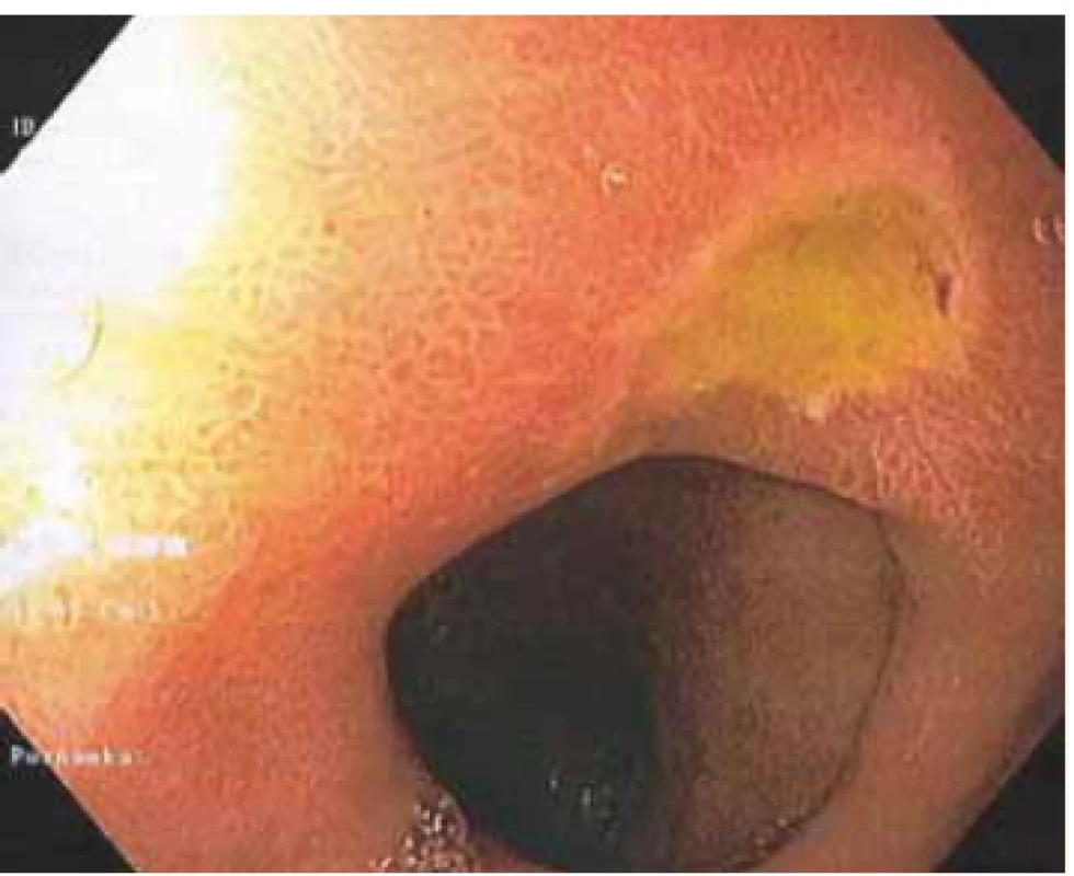 picture of ulcer on
the upper side of the prepyloric area.<br>
Obr. 1. Endoskopický obraz vredu na
hornej strane v prepylorickej oblasti.